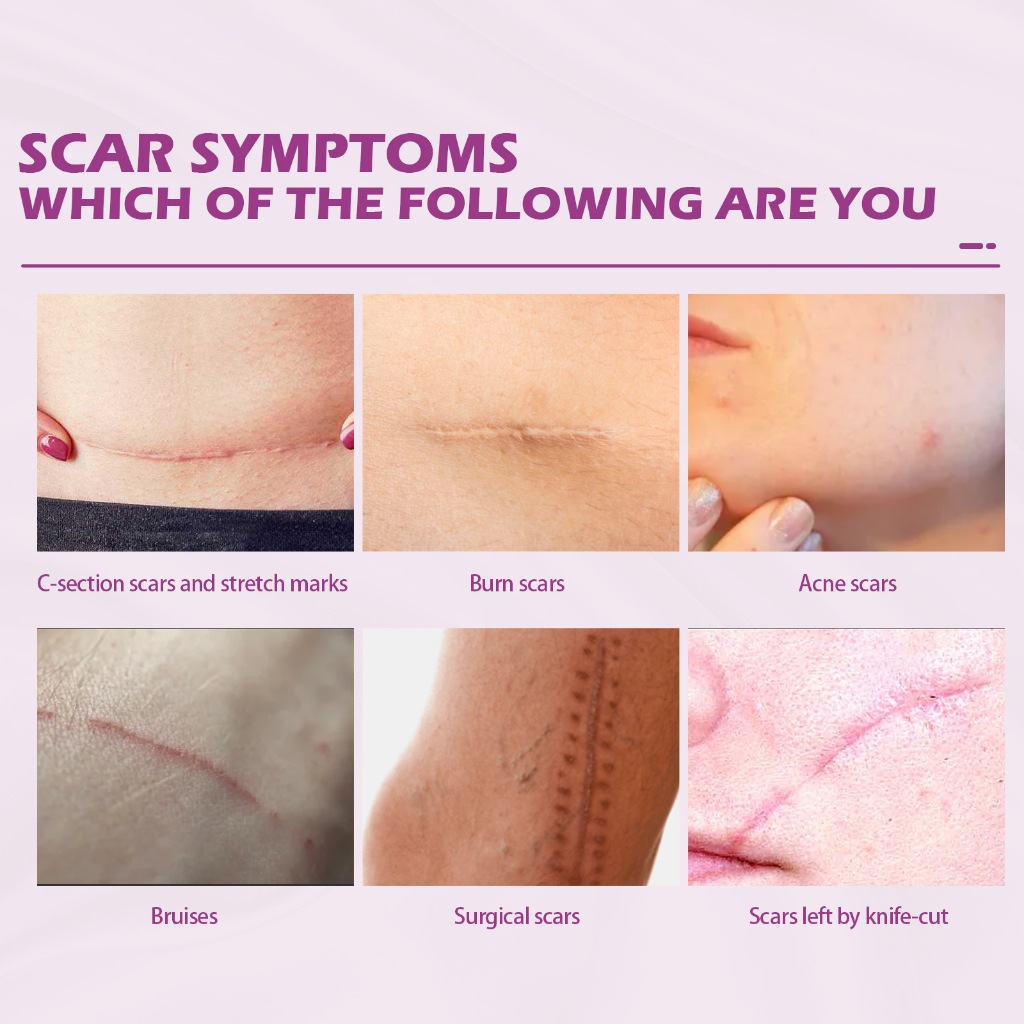 Kem sẹo Scar Removal Cream Kem Xóa Mờ Sẹo Phục Hồi Sẹo Lồi, Lõm, Mờ Vết Thâm Trả Lại Làn Da Mịn Màng