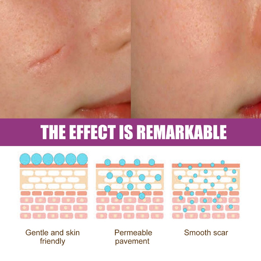 Kem sẹo Scar Removal Cream Kem Xóa Mờ Sẹo Phục Hồi Sẹo Lồi, Lõm, Mờ Vết Thâm Trả Lại Làn Da Mịn Màng