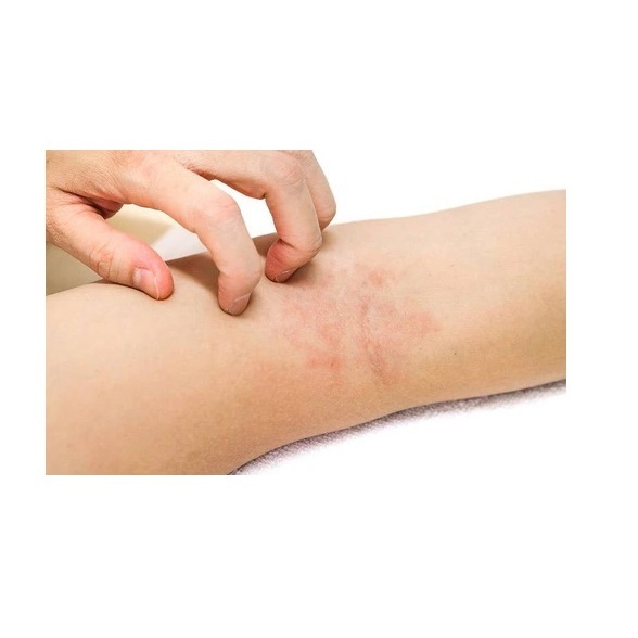 Kem Bôi Viêm Da Nấm Ngứa  Cơ Địa Nhật Bản - Kem Thảo Dược Hỗ Trợ Hắc Lào, Tổ Đỉa, Vẩy Nến, Á Sừng, Lang Ben