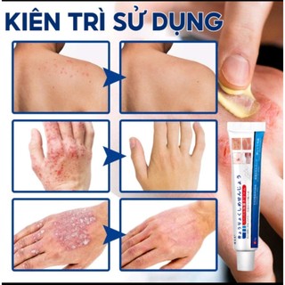 Kem Bôi Viêm Da Cơ Địa NHẬT BẢN Hỗ Trợ Dứt Điểm Lác Đồng Tiền, Nấm Da Đầu, Ghẻ Nước, Á Sừng Cực Kì Hiệu Quả