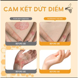 Kem Bôi Viêm Da Cơ Địa NHẬT BẢN Hỗ Trợ Dứt Điểm Lác Đồng Tiền, Nấm Da Đầu, Ghẻ Nước, Á Sừng Cực Kì Hiệu Quả