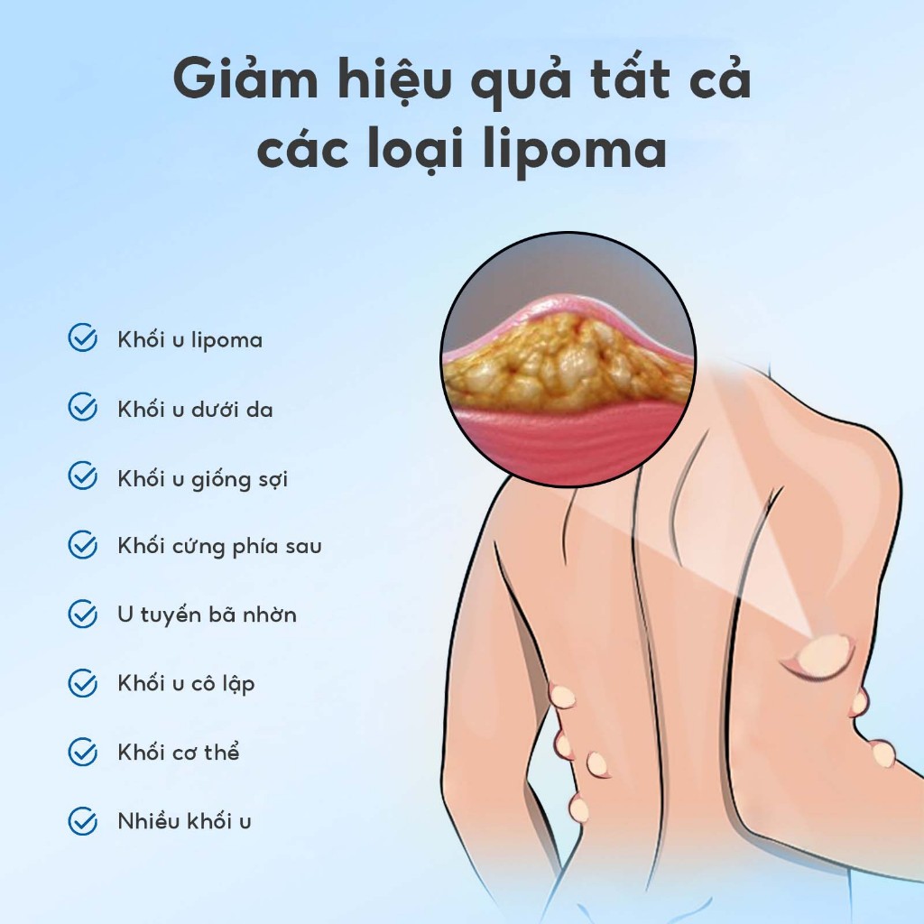 South Moon Kem loại bỏ u mỡ tan u mỡ Kem lipoma Loại bỏ mỡ dưới da Làm thông thoáng các cục mỡ 30g