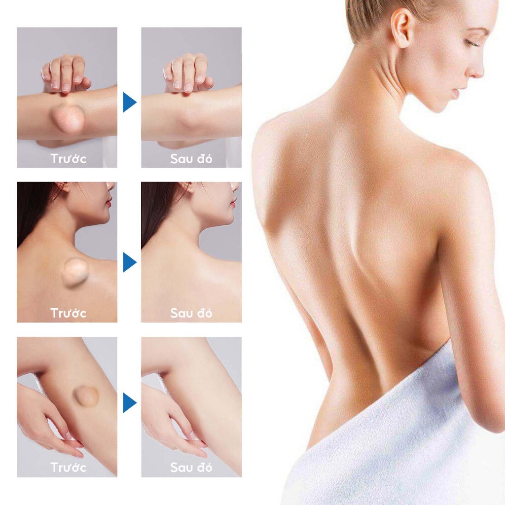 South Moon Kem loại bỏ u mỡ tan u mỡ Kem lipoma Loại bỏ mỡ dưới da Làm thông thoáng các cục mỡ 30g