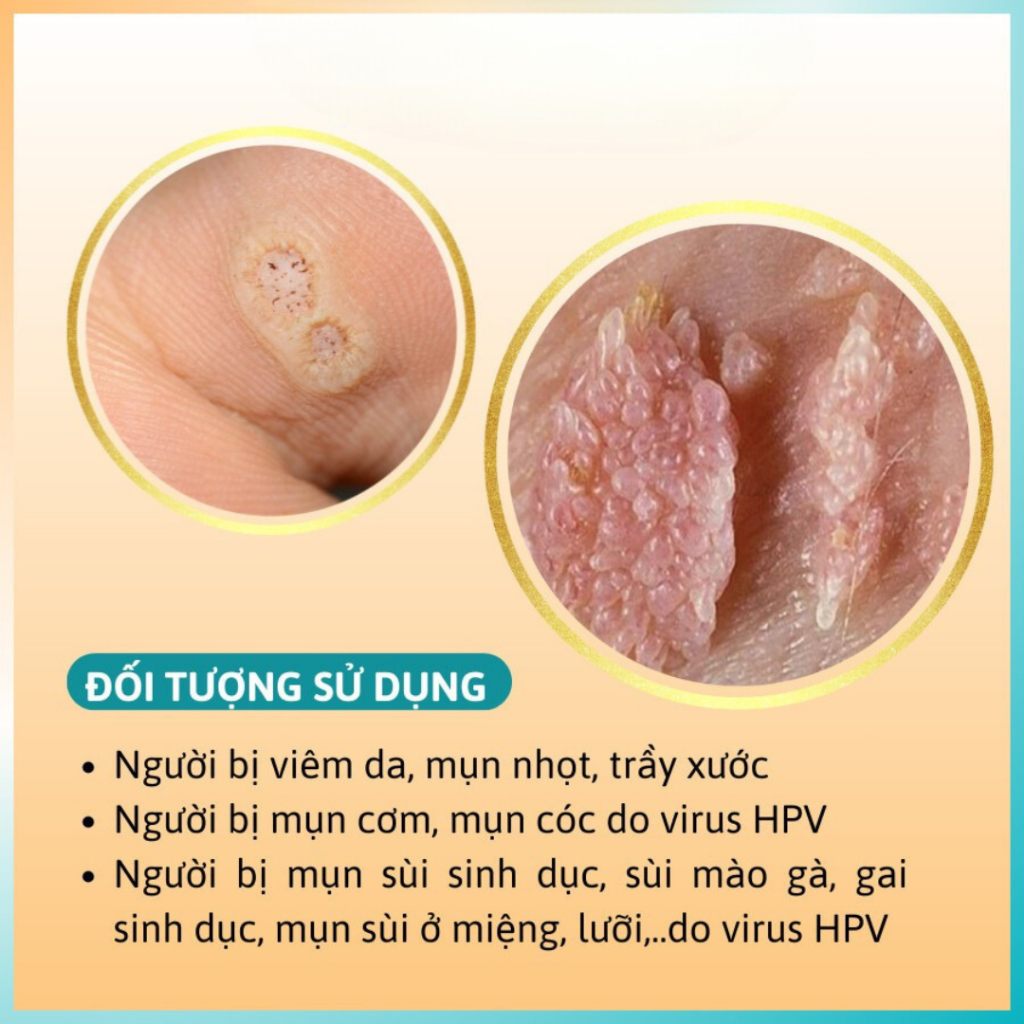 [ Che tên] Kem Bôi Sùi Mào Gà Mụn Cóc HUPAVIR Ointment Giúp Giảm Viêm Da, Mụn Cơm 20g