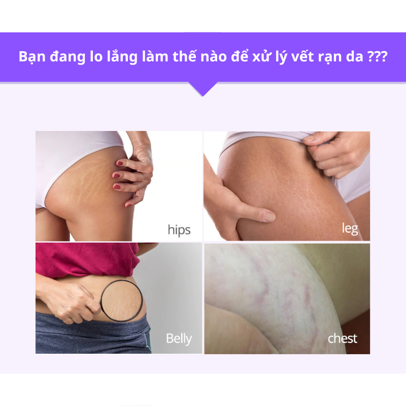 Kem Rạn Da - kem Dạn Da Sau Sinh Hỗ Trợ Giảm Sẹo Sau Sinh Làm Làm Trắng Và Săn Chắc Da Sau Sinh