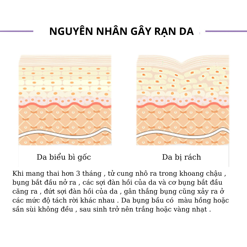 Kem Rạn Da - kem Dạn Da Sau Sinh Hỗ Trợ Giảm Sẹo Sau Sinh Làm Làm Trắng Và Săn Chắc Da Sau Sinh