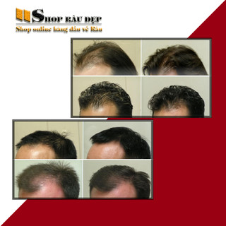 [ TẶNG 1 LCLT ] Hỗ Trợ mọc râu Minoxidil 10% Mintop