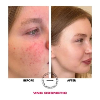 Peel mạnh vnb (2028)