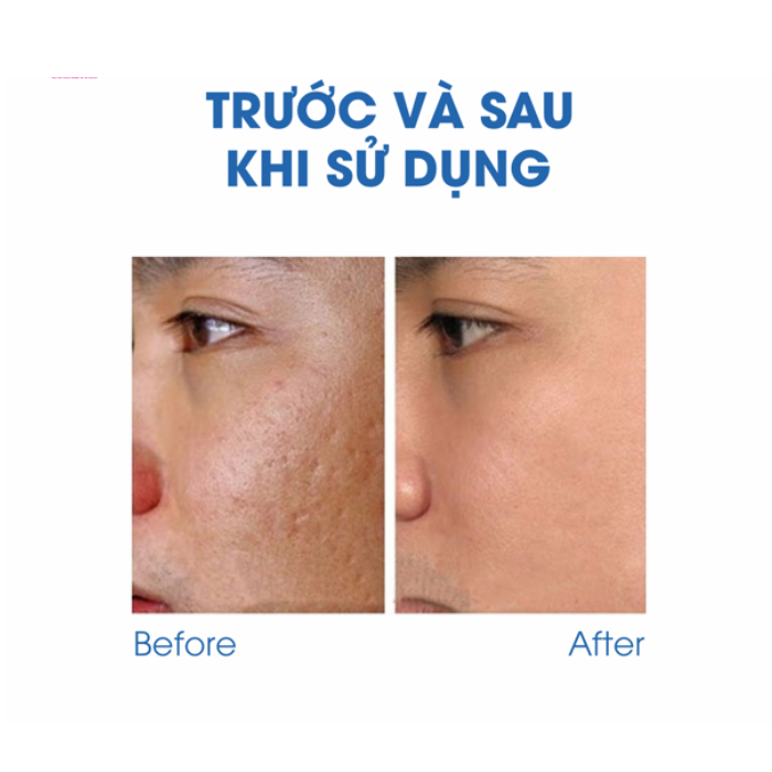 Kem Sẹo KLIRVIN NGA Mờ Sẹo Giảm Thâm Tuýp 25G