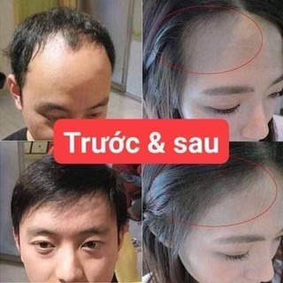 Xịt Mọc Tóc Bailleul 2% Pháp