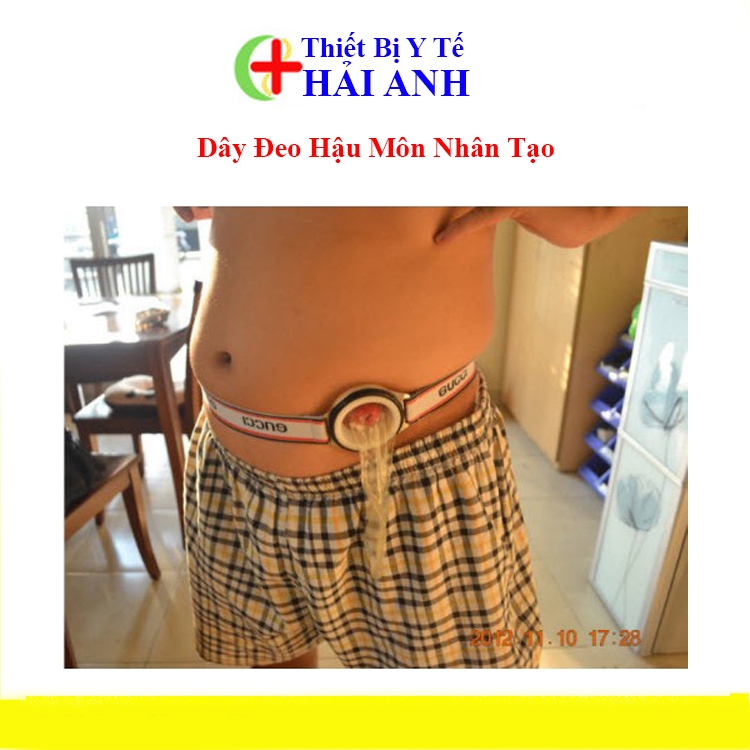 Dây Đeo Hậu Môn Nhân Tạo