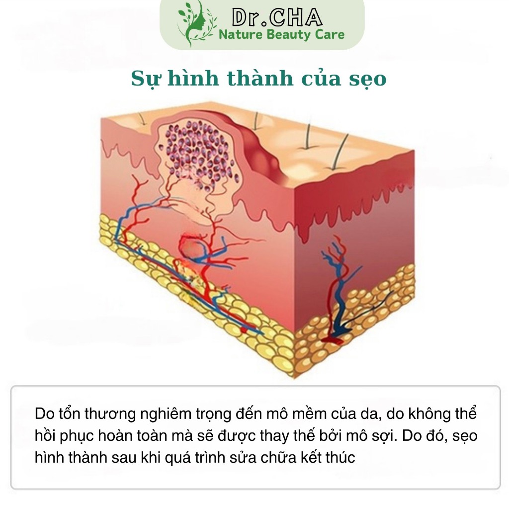 BREYLEE Kem Xoá Mờ Sẹo Hỗ Trợ Xoá Mờ Sẹo Lồi, Lõm, Bỏng Bô, Thuỷ Đậu 30g