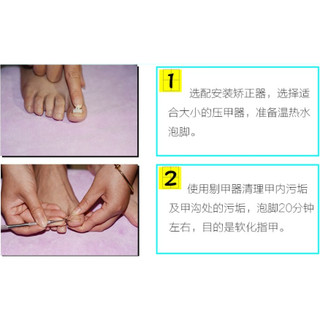 Dụng cụ hỗ trợ trị móng chân chọc thịt - móng quặp thịt (loại xịn)