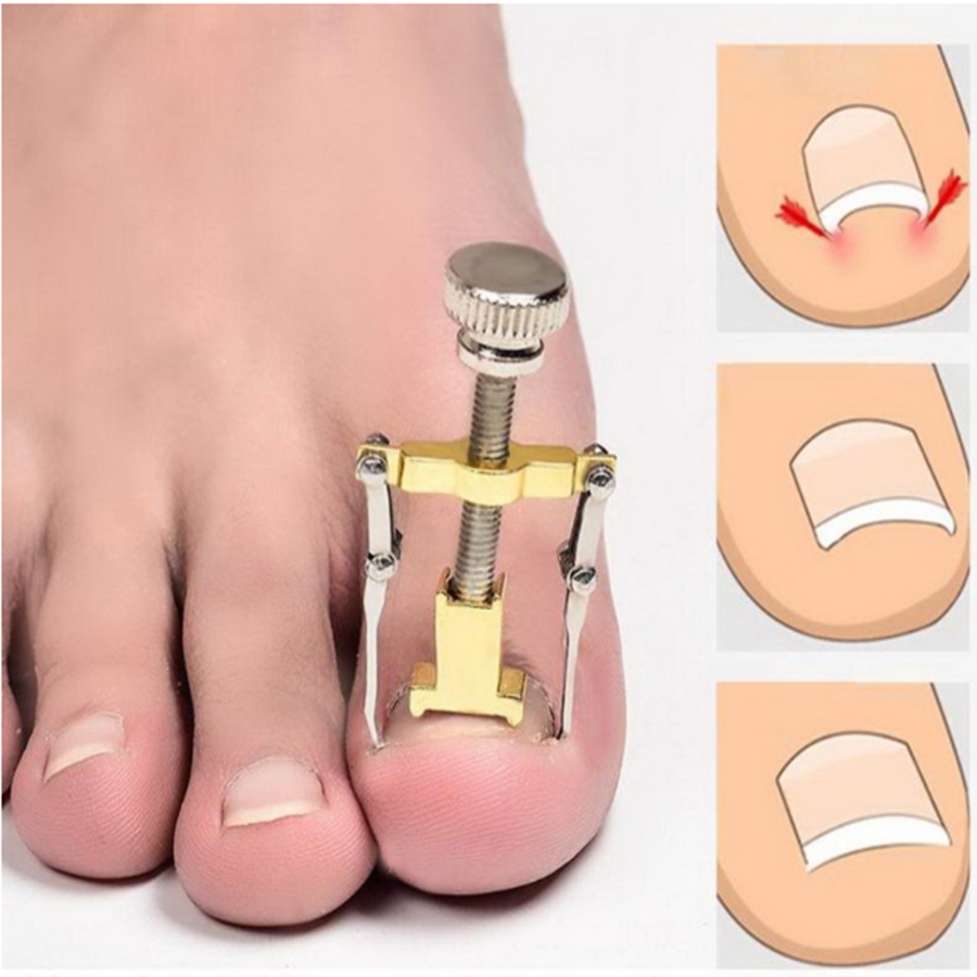 Dụng cụ hỗ trợ trị móng chân chọc thịt - móng quặp thịt (loại xịn)