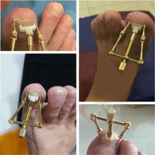 Dụng cụ hỗ trợ trị móng chân chọc thịt - móng quặp thịt (loại xịn)