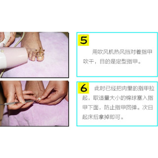 Dụng cụ hỗ trợ trị móng chân chọc thịt - móng quặp thịt (loại xịn)