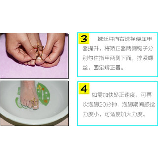 Dụng cụ hỗ trợ trị móng chân chọc thịt - móng quặp thịt (loại xịn)