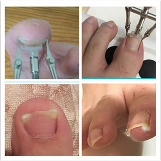 Dụng cụ hỗ trợ trị móng chân chọc thịt - móng quặp thịt (loại xịn)
