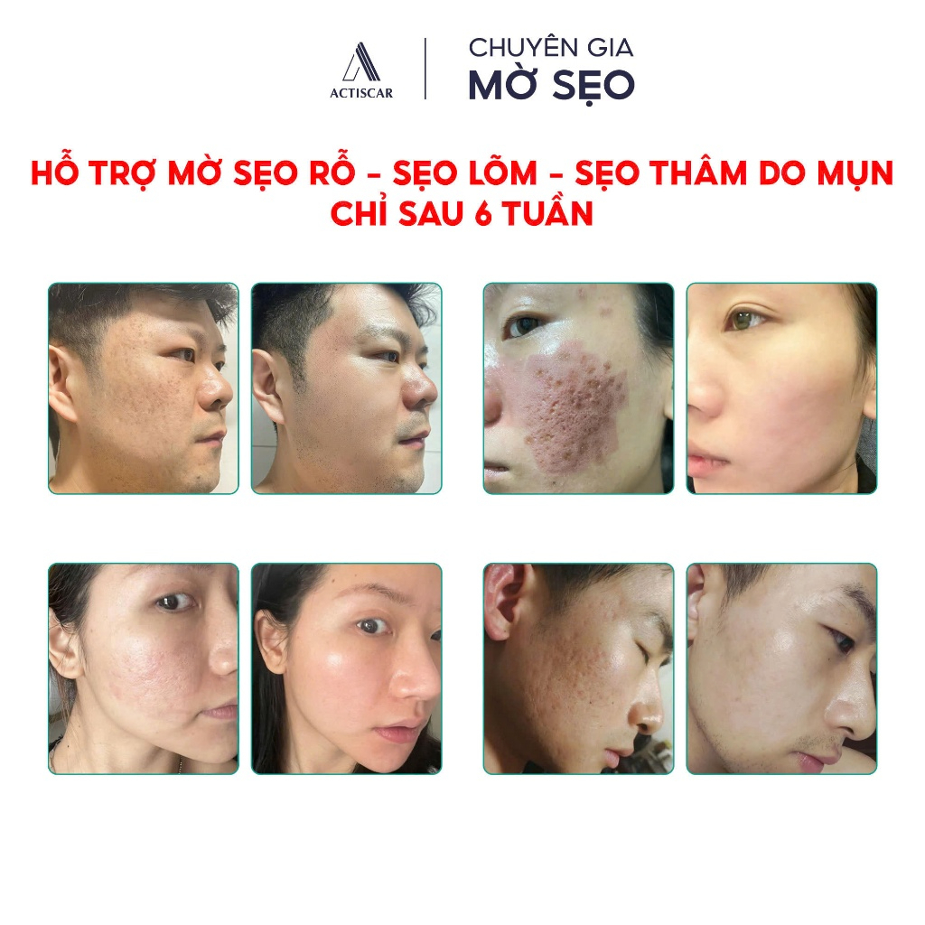 Kem Sẹo Và Serum Chuyên Sâu Lấp đầy Sẹo Rỗ, Sẹo Lõm, Xóa Sạch Sẹo Thâm Lâu Năm Actiscar