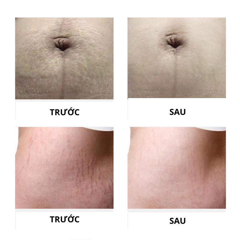 Combo Bộ 3 Chăm Sóc Sắc Đẹp Cho Mẹ Sau Sinh An Toàn Hiệu Quả Kem Nám Tàn Nhang ,Rạn Da , Kem Tan Mỡ