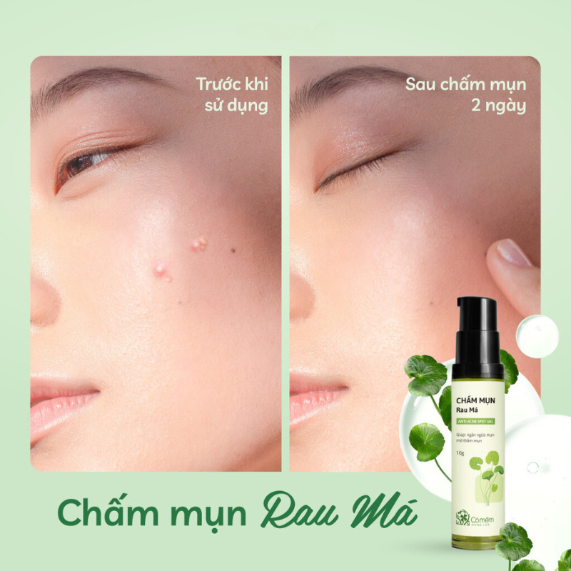 Chấm Mụn Rau Má Giảm Mụn Viêm Sưng Đỏ Mụn Cóc Mụn Bọc Mụn Trứng Cá Cỏ Mềm 10gr