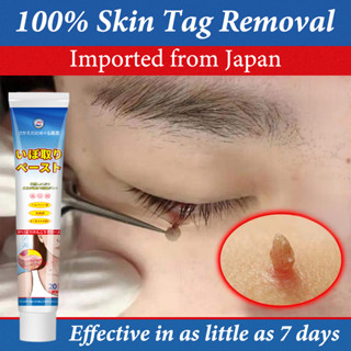 Kem mụn cóc Kem tẩy nốt ruồi mụn cóc Loại bỏ mụn cóc và mụn thịt vĩnh viễn Nhanh chóng an toàn và không đau 20g