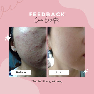 Kem Omai Mụn, Mờ Thâm, Mờ Sẹo, Skincare Da Trắng Hồng Chiếc Xuất Thiên Nhiên Nhật Bản Kem Face Ngày Đêm Trắng Da