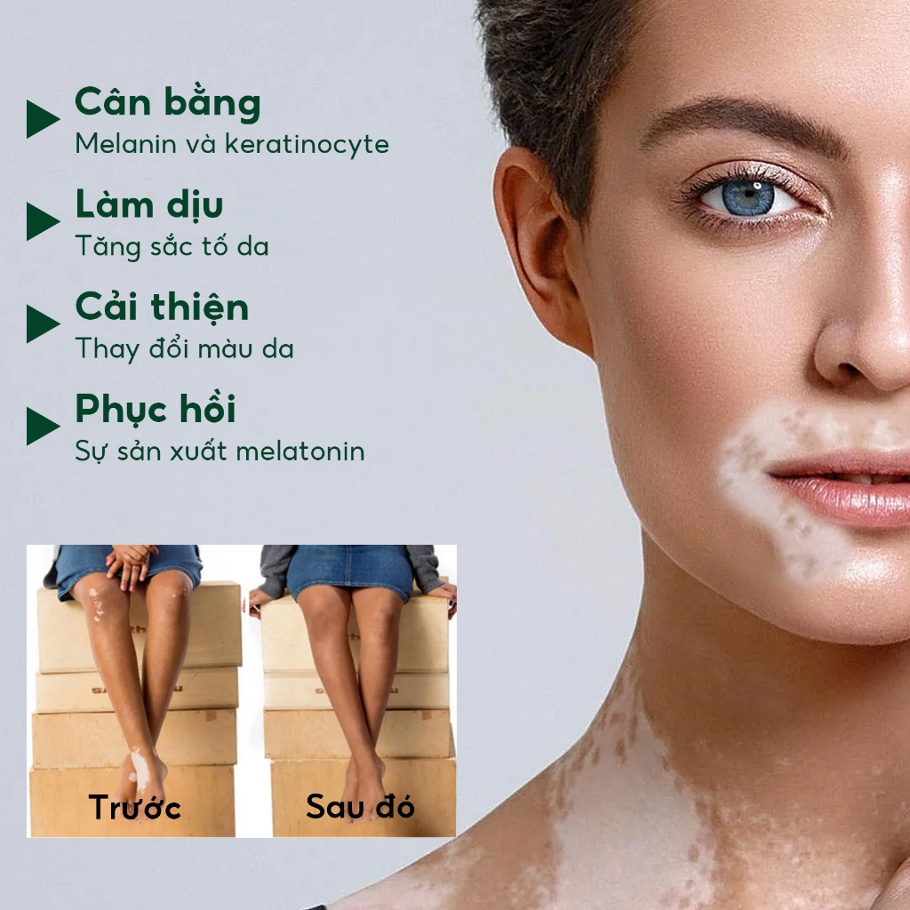 South Moon Kem bôi Lang Ben dứt điểm Bạch Biến phục hồi sắc tố da nhanh chóng  hiệu quả 35g