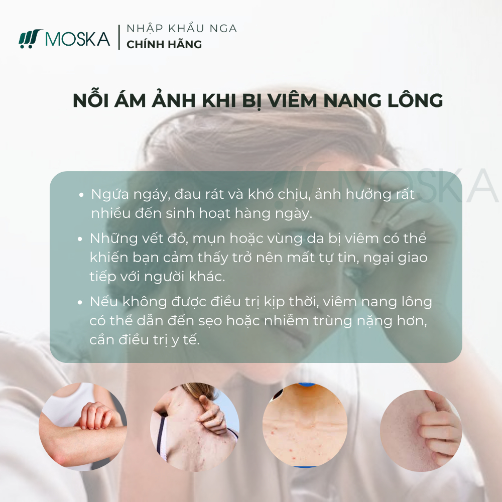KEM DA LIỄU GIẢM VIÊM NANG LÔNG UREA ĐÀO THẢI BÍT TẮT LỖ CHÂN LÔNG ĐÁNH BAY VIÊM KHÔI PHỤC LÀN DA TƯƠI SÁNG 200ML |Moska