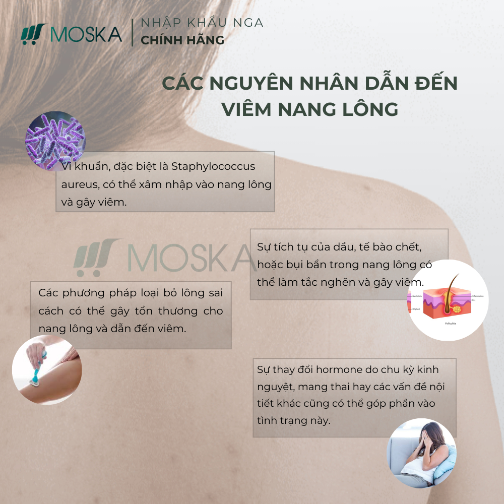 KEM DA LIỄU GIẢM VIÊM NANG LÔNG UREA ĐÀO THẢI BÍT TẮT LỖ CHÂN LÔNG ĐÁNH BAY VIÊM KHÔI PHỤC LÀN DA TƯƠI SÁNG 200ML |Moska