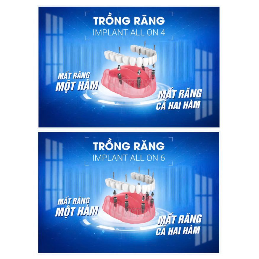 Tranh "Trồng răng implant all on 4", " Trồng răng implant all on 6" - chất liệu dán DECAL hoặc FOMEX