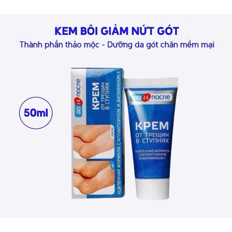 Kem bôi giảm nứt nẻ gót chân Before and After Kpem Foot Cream for Cracked Feet 50ml