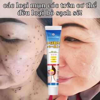 kem bôi loại bỏ mụn cóc mụn thịt Mụn cóc sinh dục mụn cóc dạng sợi mụn cóc lòng bàn chân an toàn hiệu quả không đau