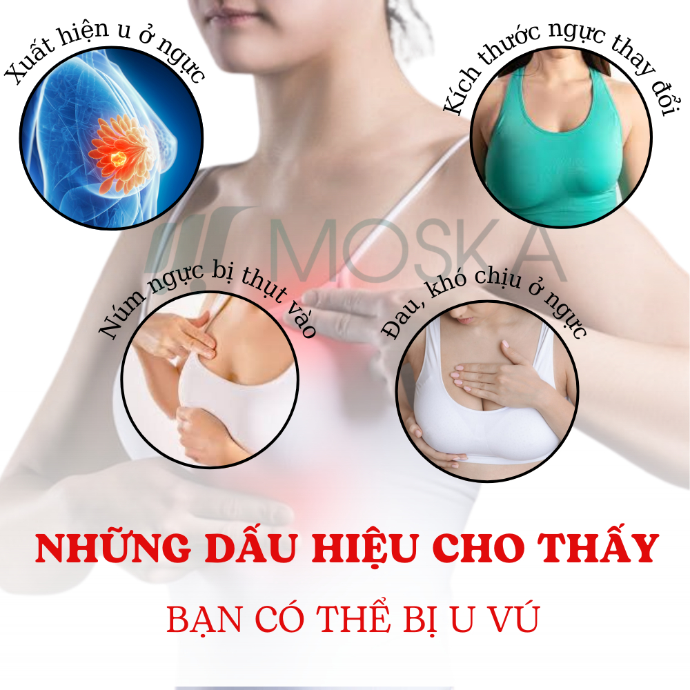 KEM TAN U TUYẾN VÚ SAKURARIN NHẬT BẢN 50G GIẢM SƯNG ĐAU CĂNG TỨC NGỰC, TIÊU BIẾN U CỤC Ở VÚ, LOẠI BỎ U TUYẾN VÚ THẮT NÚT