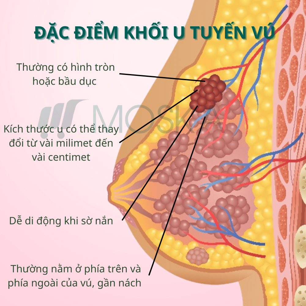 KEM TAN U TUYẾN VÚ SAKURARIN NHẬT BẢN 50G GIẢM SƯNG ĐAU CĂNG TỨC NGỰC, TIÊU BIẾN U CỤC Ở VÚ, LOẠI BỎ U TUYẾN VÚ THẮT NÚT