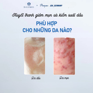 Huyết thanh mụn Jean D'arcel