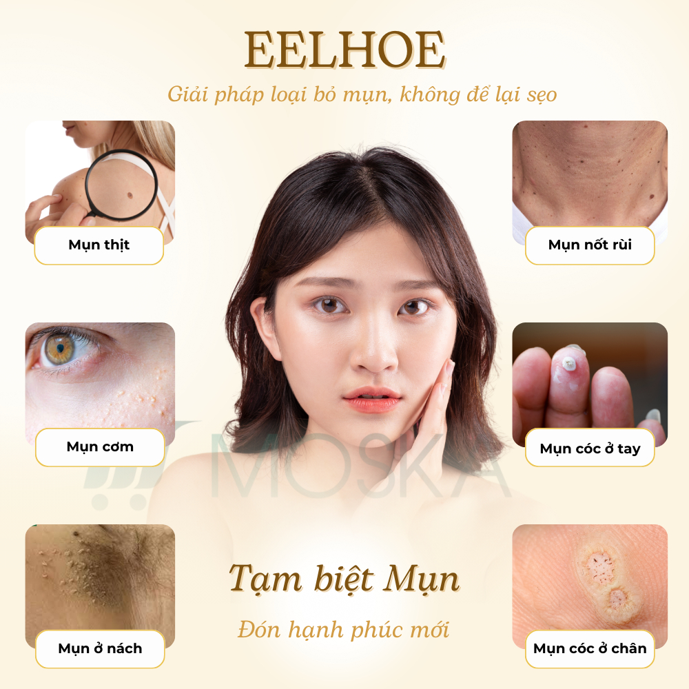 WART REMOVAL EELHOE MỸ 20GR - Kem Bôi Thảo Mộc Không Rát, Tẩy Mụn Thịt Quanh Mắt, Mụn Cóc, Mụn Ruồi, Mụn Gạo | MOSKA