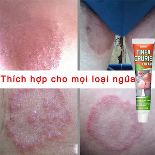 kem bôi nấm ngứa vùng kín giảm ngứa da bôi ngứa da bôi hắc lào nấm ngứa bôi ngoài da ghẻ ngứa bệnh chàm bệnh vảy nến