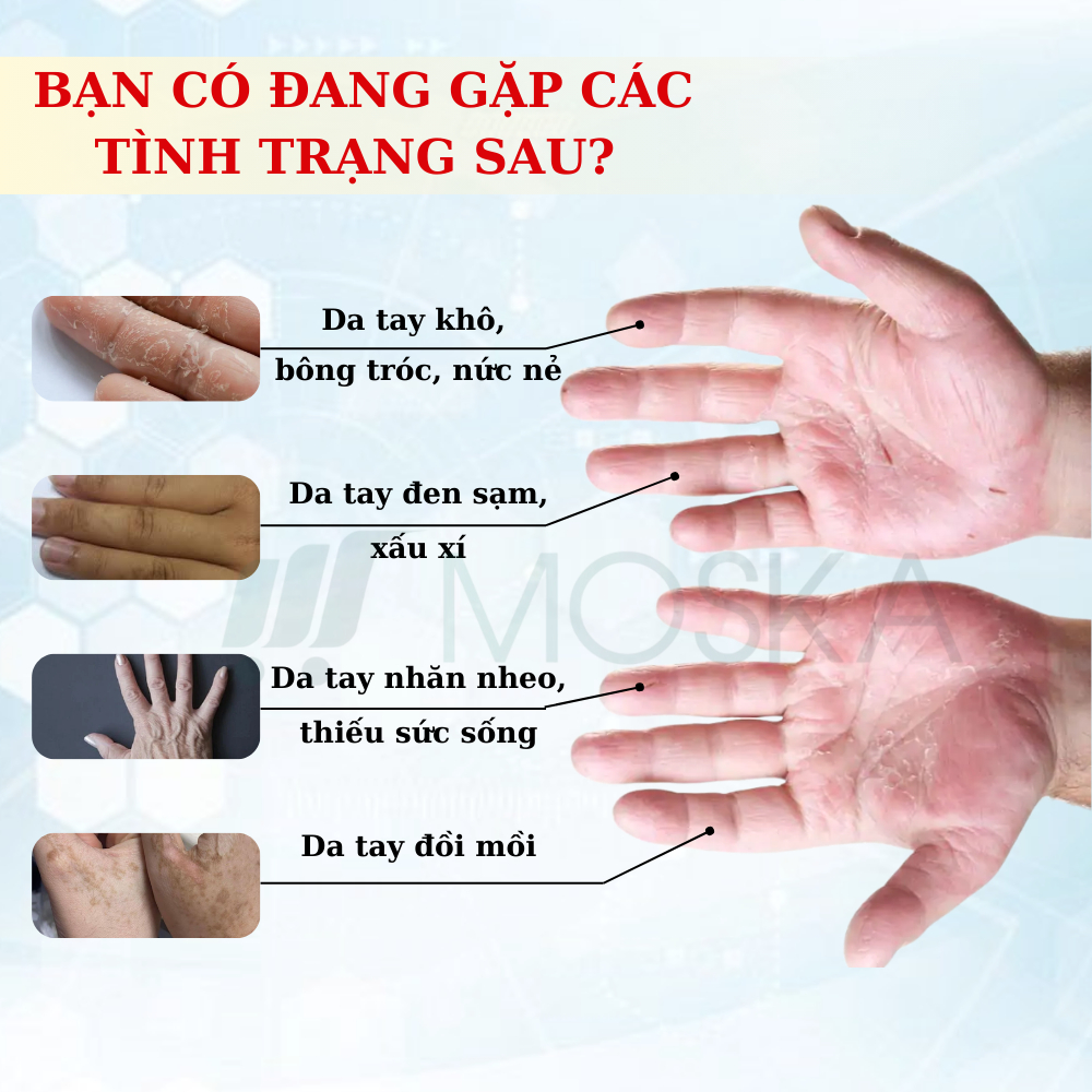Kem Dưỡng Da Tay Đông Y GOLDEN SNAKE – Cấp Ẩm, Xoá Nếp Nhăn, Da Mềm Mịn, Tăng Cường Độ Đàn Hồi, Bảo Vệ Da Tay | MOSKA