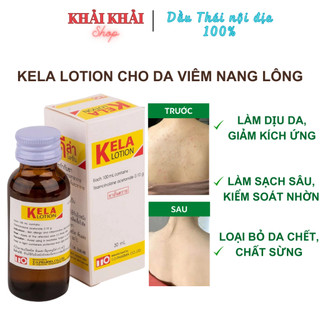   Nội địa Thái  Kela Lotion Cho Da Viêm nang lông viêm lỗ chân lông Kela Lotion giúp da mịn màng 30ml 60ml 