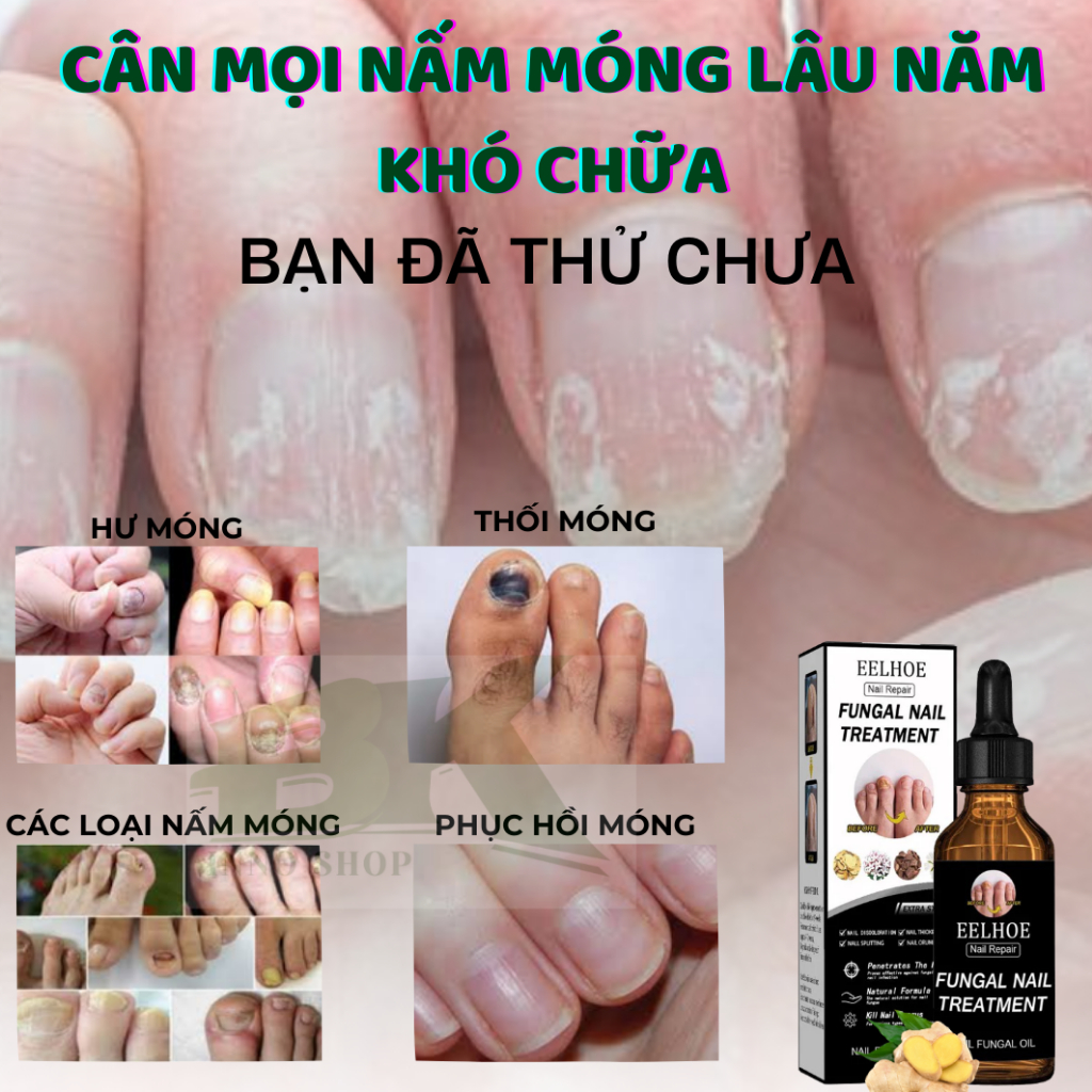 Tinh Chất Diệt Nấm Móng Thảo Dược EELHOE Mỹ 30ml Loại Bỏ Nấm Móng Tay Chân, Thối Móng Dưỡng Móng Cứng Chắc Khỏe| BK INNO