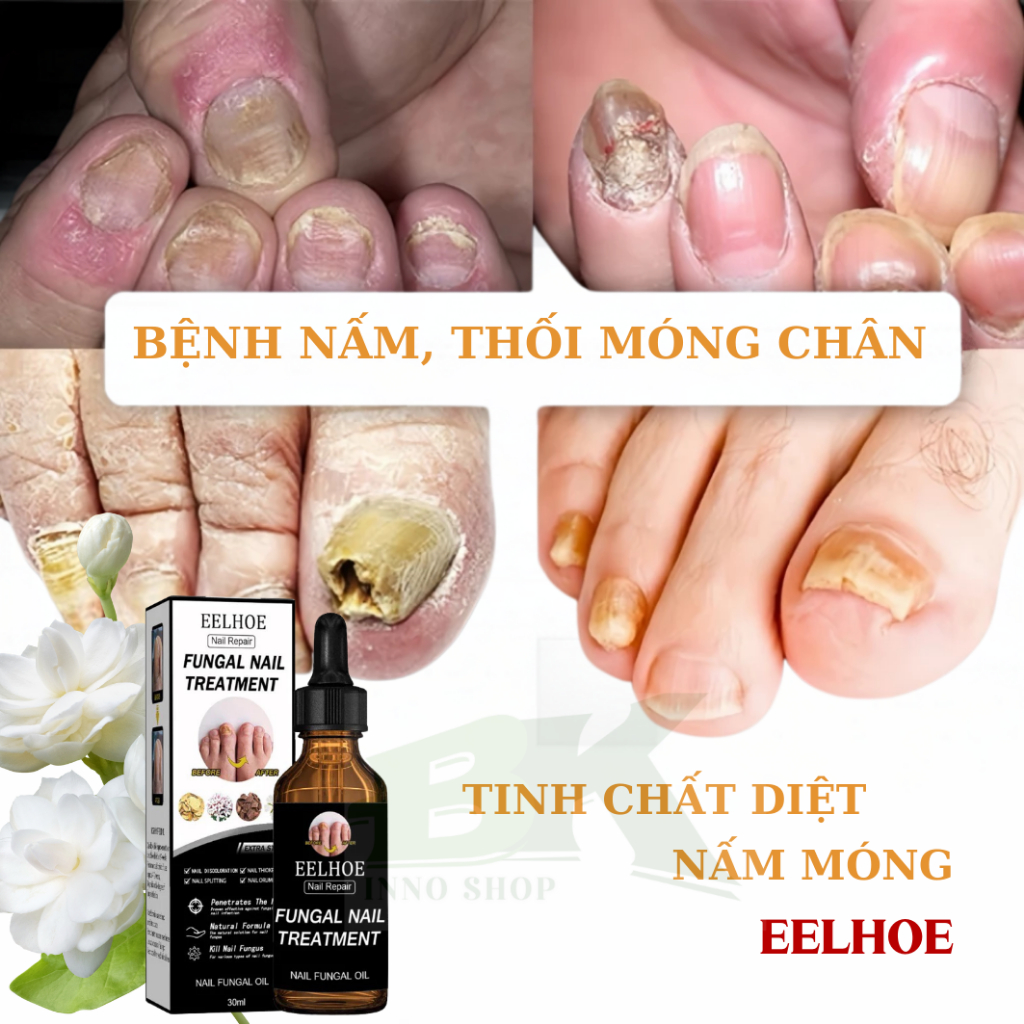 TINH CHẤT LOẠI BỎ NẤM MÓNG THẢO DƯỢC EELHOE MỸ – TIÊU TRỪ NẤM MÓNG,THỐI MÓNG, VIÊM MÓNG, DƯỠNG MÓNG CHẮC KHỎE | BK INNO