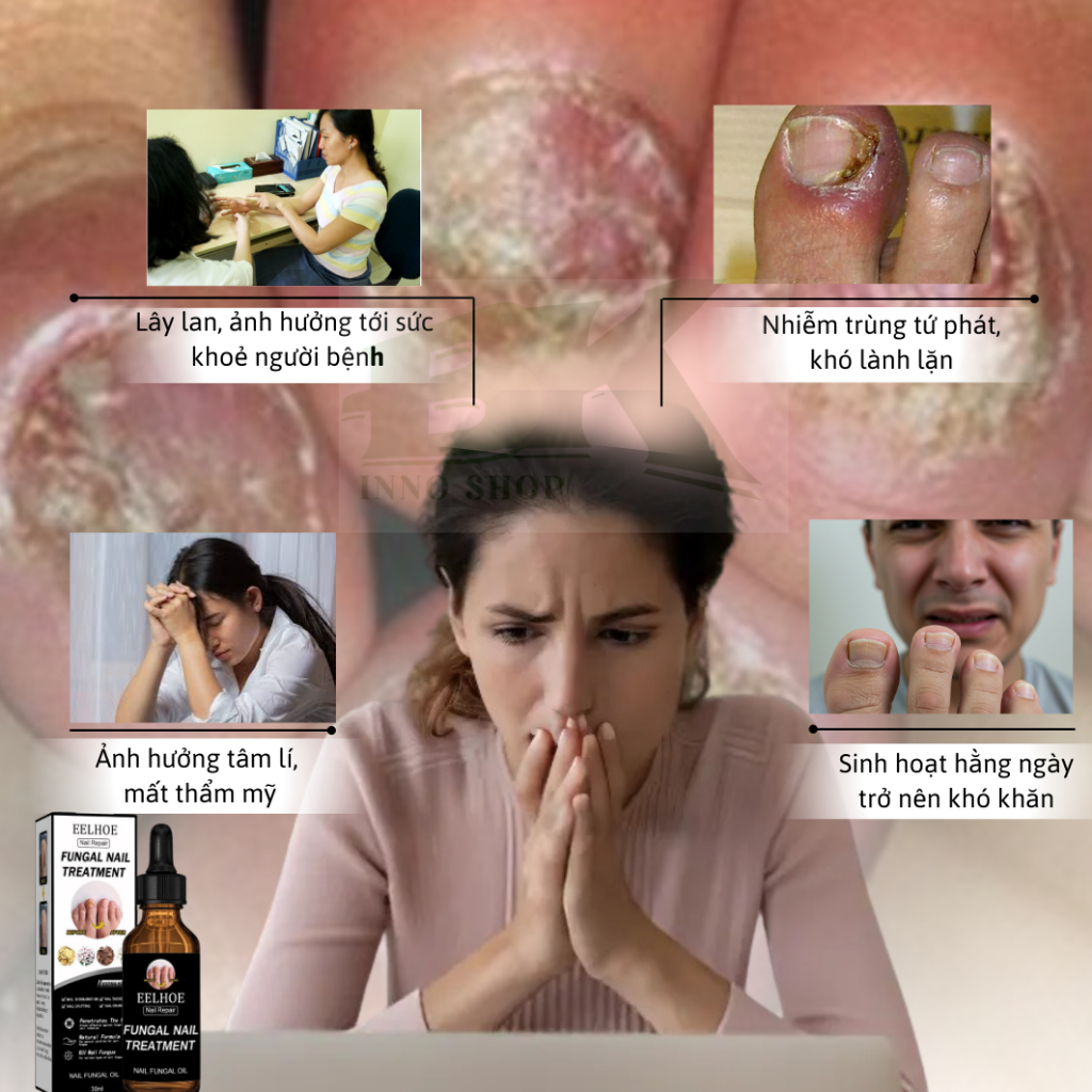 TINH CHẤT LOẠI BỎ NẤM MÓNG THẢO DƯỢC EELHOE MỸ – TIÊU TRỪ NẤM MÓNG,THỐI MÓNG, VIÊM MÓNG, DƯỠNG MÓNG CHẮC KHỎE | BK INNO