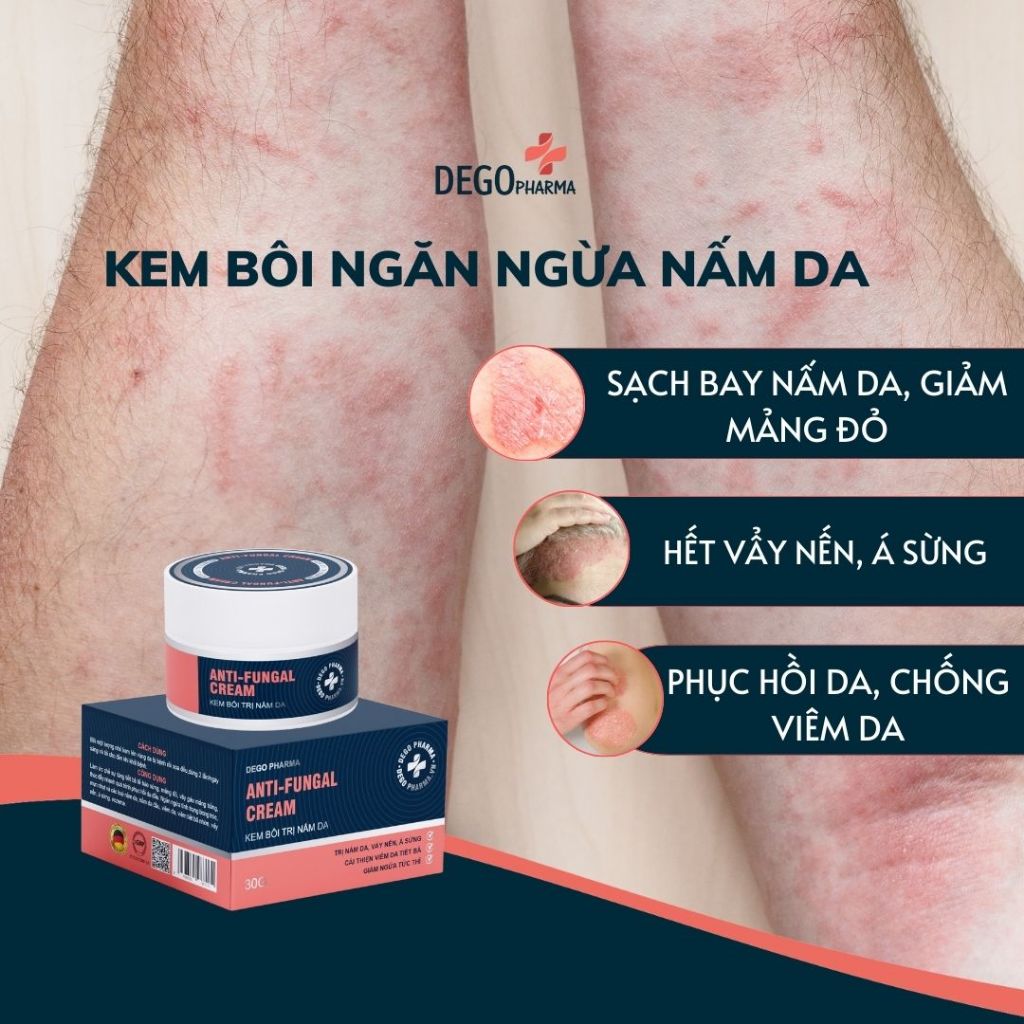 Kem bôi nấm da hắc lào mề đay vảy nến á sừng eczema Dego Pharma 30g