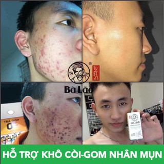 [MUA 1 TẶNG 3] Serum Mụn Thâm Sẹo Cao Cấp Bà Lão Dành Cho Mọi Loại Da Kèm Mặt Nạ Dưỡng