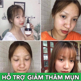 [MUA 1 TẶNG 3] Serum Mụn Thâm Sẹo Cao Cấp Bà Lão Dành Cho Mọi Loại Da Kèm Mặt Nạ Dưỡng