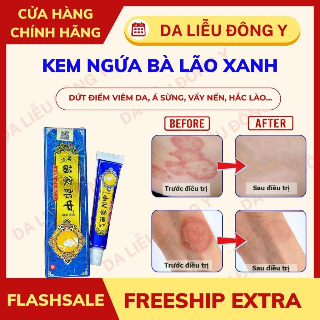 [Chính Hãng] Kem Bôi Nấm Ngứa Da BÀ LÃO XANH Thảo Dược Hỗ Trợ Dứt điểm Hắc Lào Nấm Ngứa Á Sừng Lang Ben Vẩy Nến