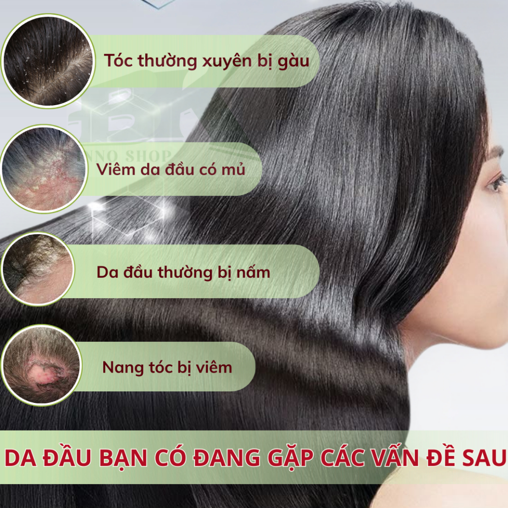 Kem Bôi Viêm Nang Lông Tóc IWAI Phục Hồi Da Đầu, Giảm Viêm, Kháng Khuẩn, Phục Hồi Nang Tóc, Giúp Tóc Chắc Khoẻ | BK INNO