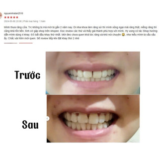 Khay niềng răng trong suốt True Smile (cần mẫu hàm răng )