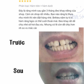 Khay niềng răng trong suốt True Smile (cần mẫu hàm răng )